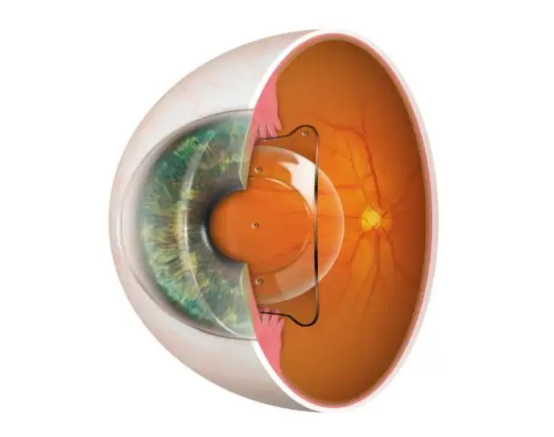 合肥爱尔：角膜薄可以做近视手术吗？