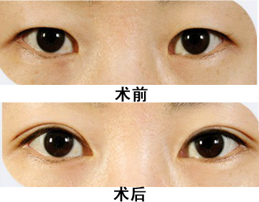 徐州医科汇美美容医院李均友院长解答：开眼角手术的作用有哪些呢