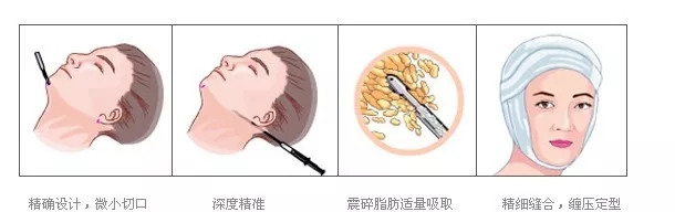 面部美学与技术结合 杭市一王宇燕医生研发新一代面部吸脂针专利技术