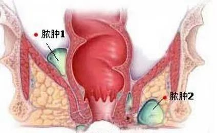 贵阳东大肛肠医院：肛周脓肿的九大危害，你了解多少？