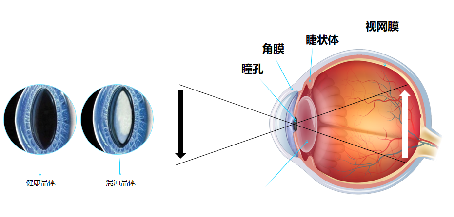 【合肥爱尔】白内障怎么自查才靠谱？哪些症状值得警惕？