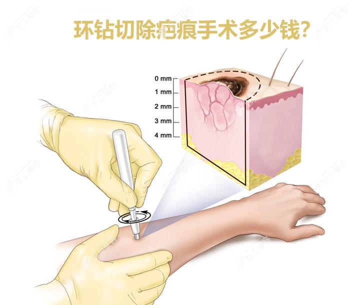 白色瘢痕的微创修复：新疆威兹曼环钻植皮技术详解