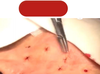 新疆威兹曼：增生性瘢痕患者的新希望