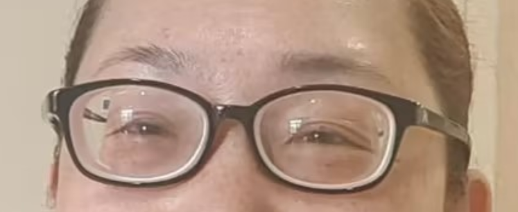 【福州爱尔】女子近视1700度，更换眼镜依旧看不清！医生：警惕高度近视并发性白内障